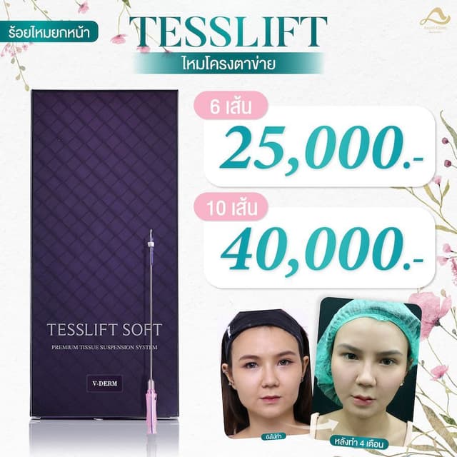 Tesslift